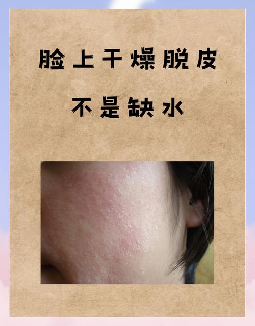 为什么脸上掉皮屑