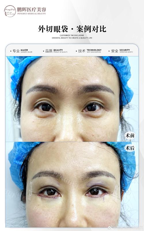 什么去眼袋效果最好