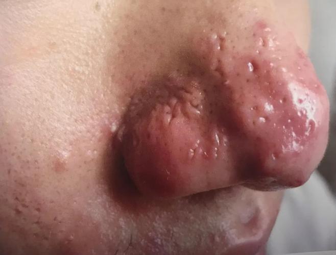 为什么鼻子老长痘