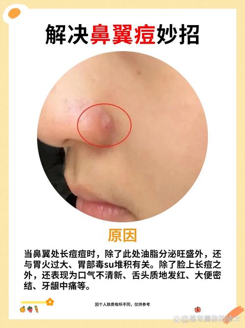 为什么鼻子老长痘