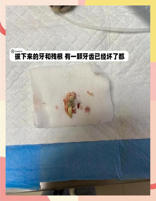 为什么拔牙那么贵