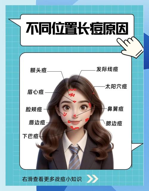 长痘痘是什么体质