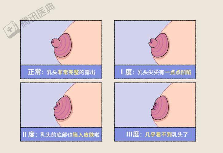 正常的乳头是什么样的