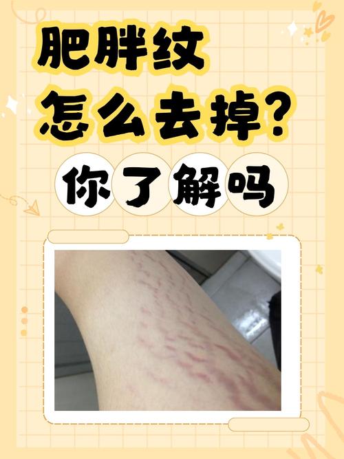 减肥为什么会有胖纹