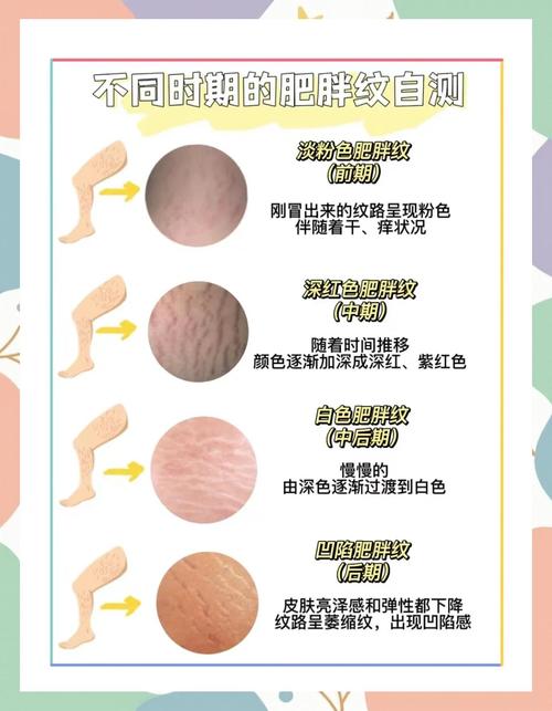 减肥为什么会有胖纹