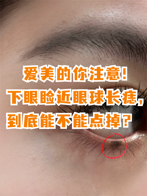 下眼睑有痣代表什么