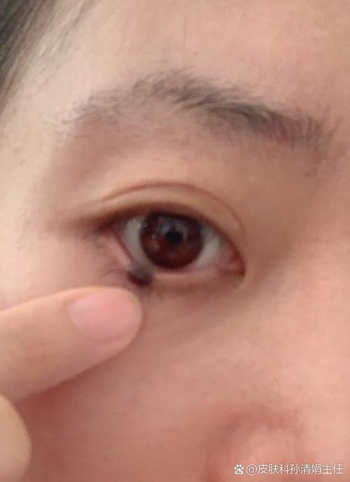 下眼睑有痣代表什么