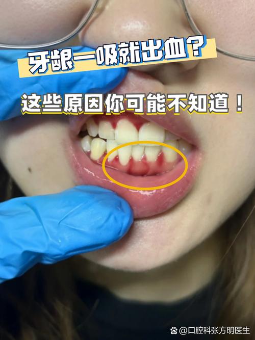 为什么牙齿老是出血