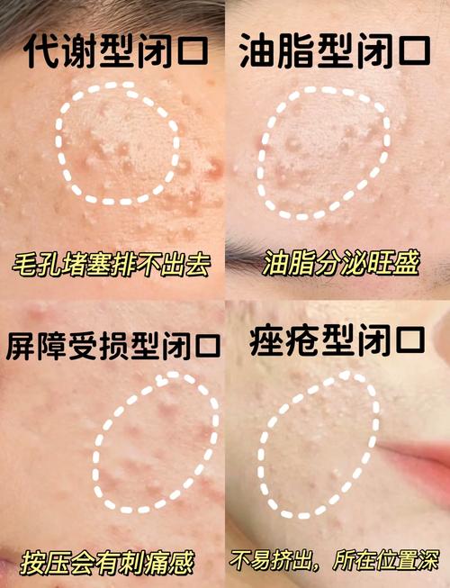 为什么有闭口粉刺
