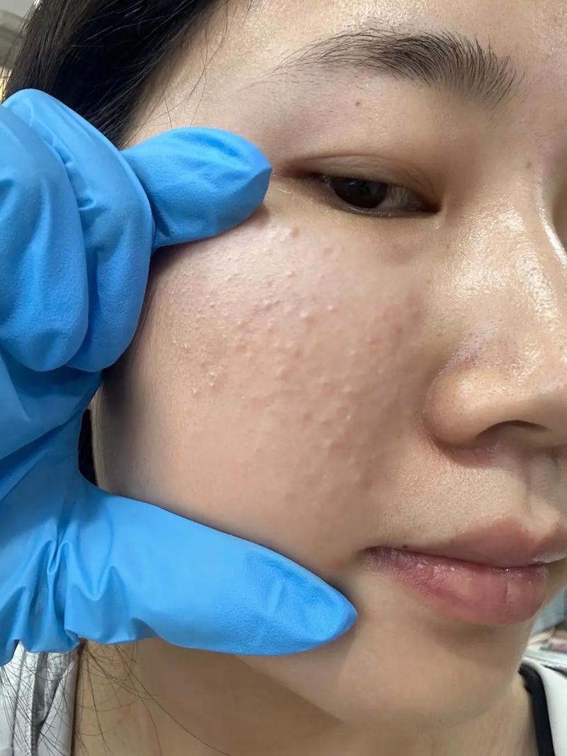 为什么有闭口粉刺