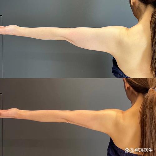 为什么减肥后手臂松弛