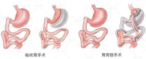 做什么手术减肥安全