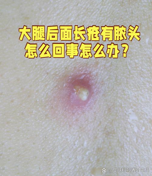 身上长疮是什么原因