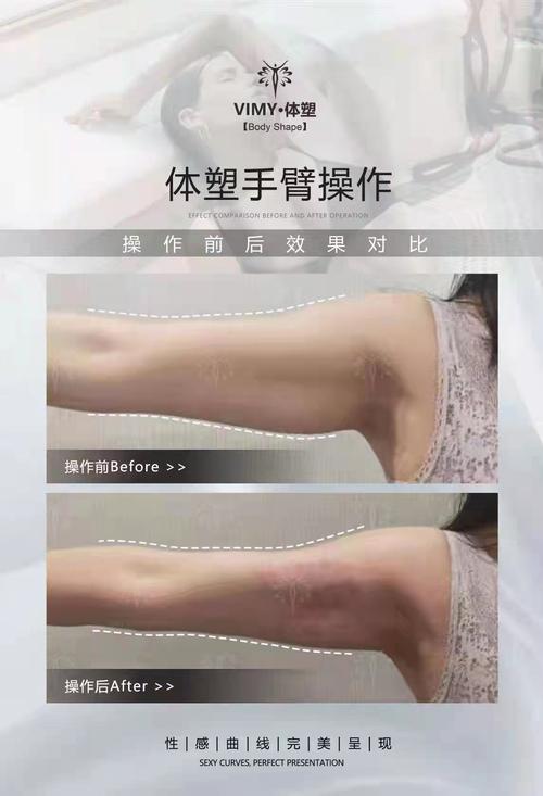 脂肪刀减肥是什么意思