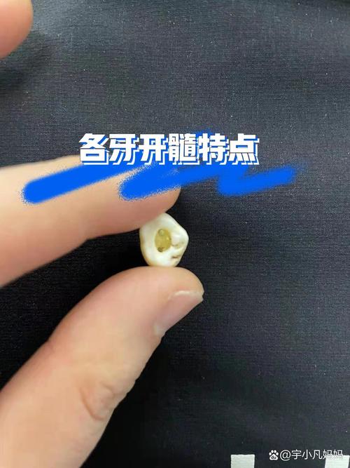 牙髓长什么样