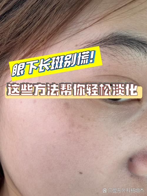 眼睛下面是什么斑