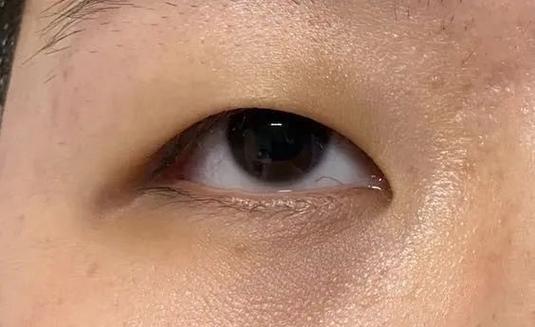 节食减肥为什么脸会肿