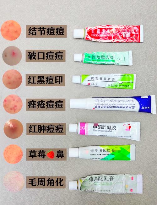 长闭口涂什么药膏