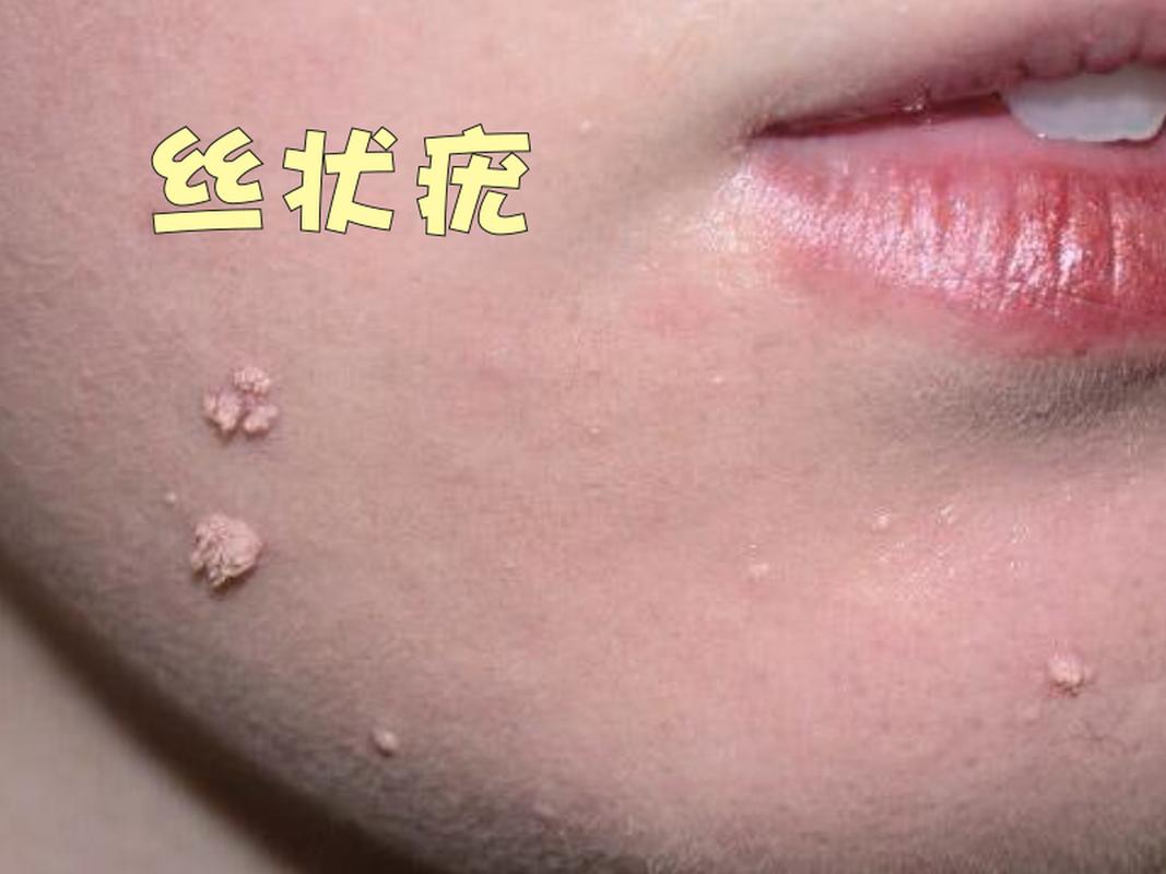 什么是皮肤疣