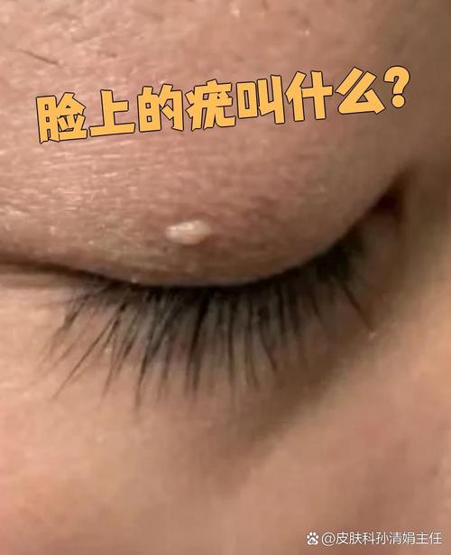 什么是皮肤疣