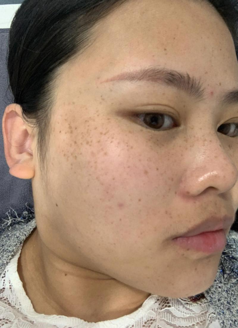 黄褐斑是什么样的