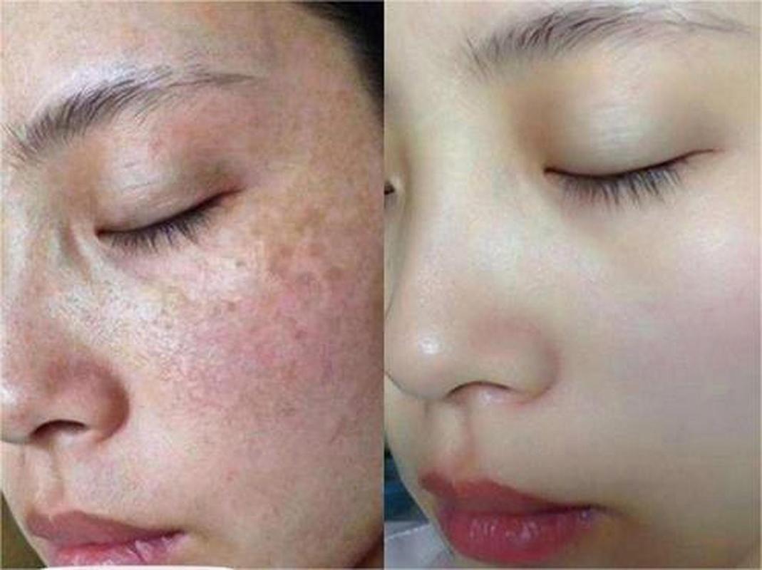 黄褐斑是什么样的