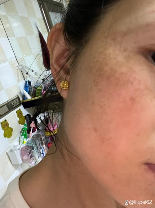 黄褐斑是什么样的