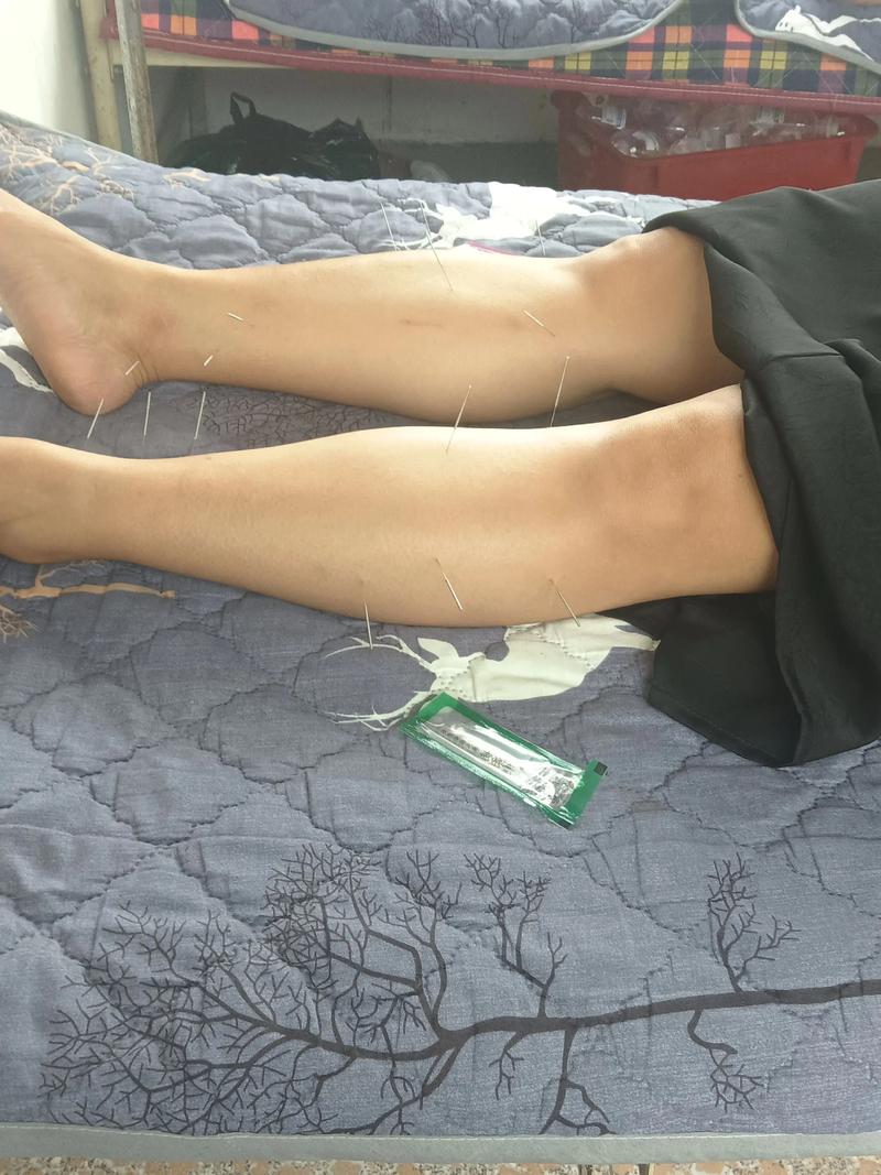 什么人针灸减肥无效果