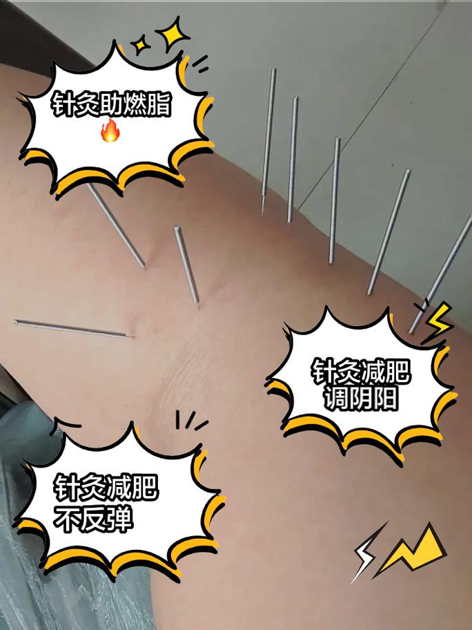 什么人针灸减肥无效果