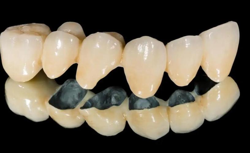 什么烤瓷牙比较好