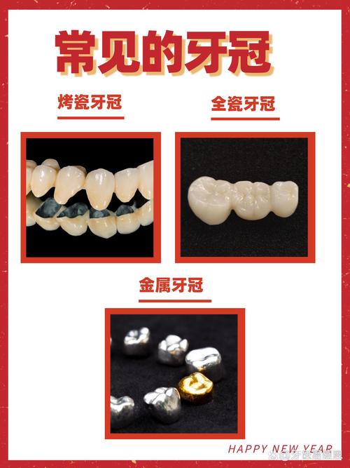 什么烤瓷牙比较好