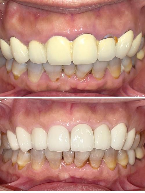 什么烤瓷牙比较好