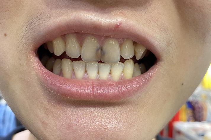 牙髓炎是什么症状