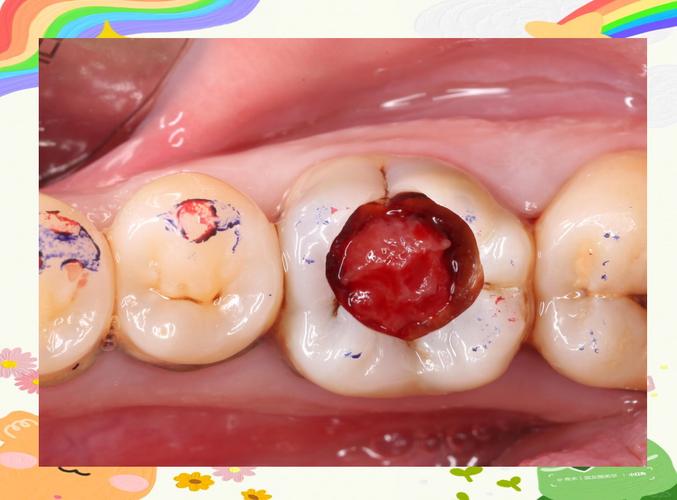 牙髓炎是什么症状