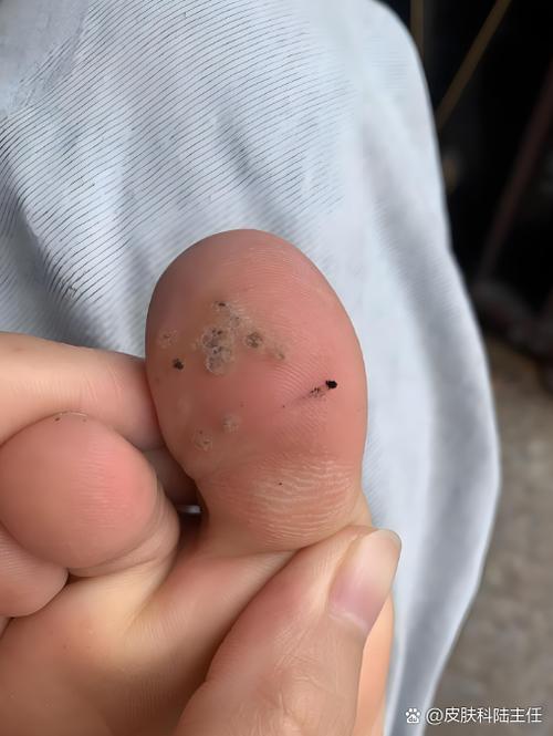 跖疣有什么症状