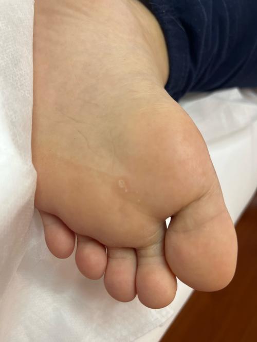 跖疣有什么症状