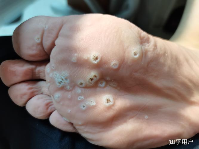 跖疣有什么症状