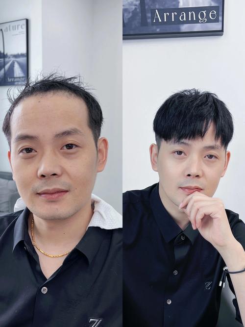 男人为什么掉头发