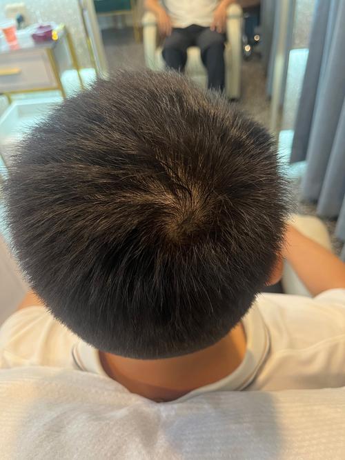 男人为什么掉头发