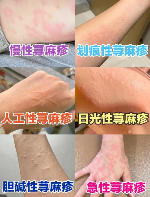 什么是荨麻疹病