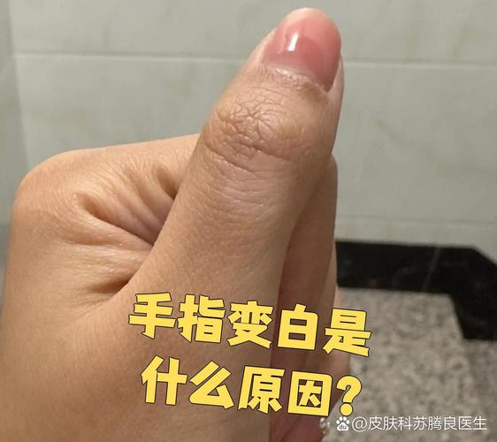 手上有白斑是什么