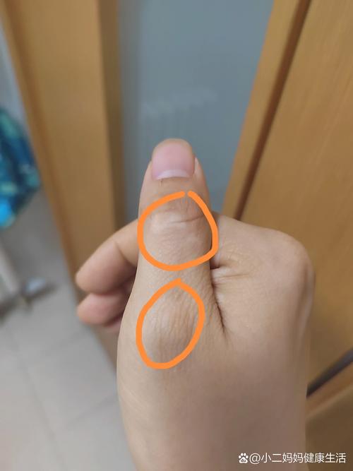 手上有白斑是什么