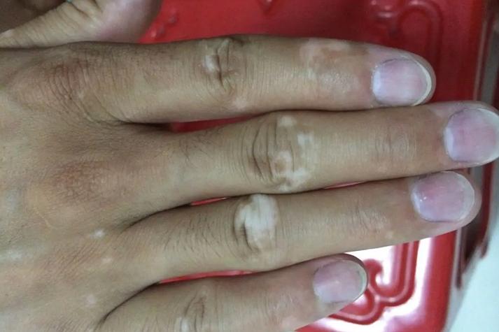 手上有白斑是什么