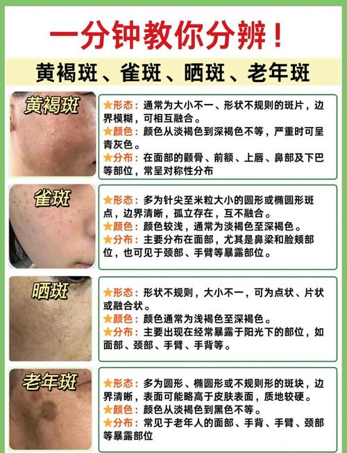 长黄褐斑是什么原因