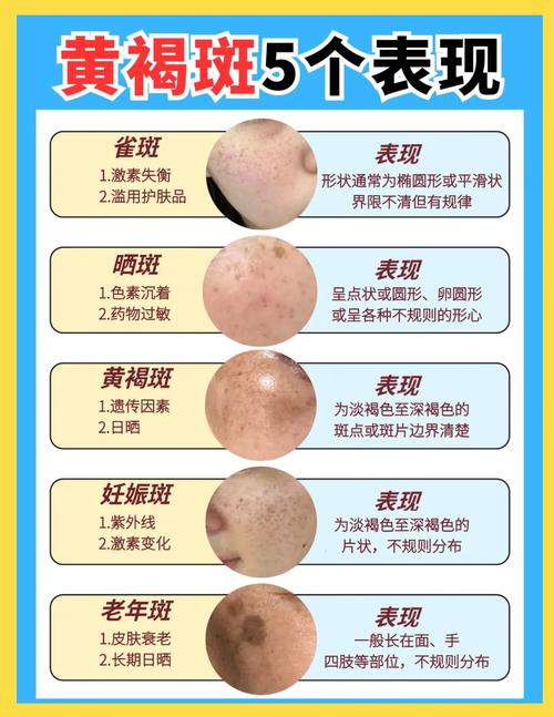 长黄褐斑是什么原因