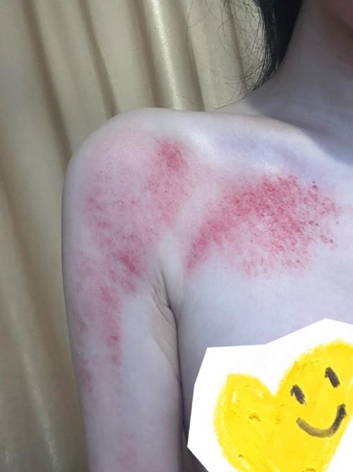 刮痧出的痧是什么