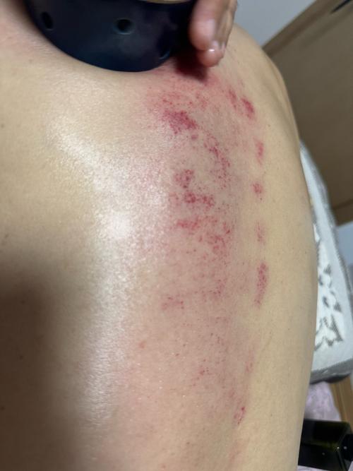 刮痧出的痧是什么