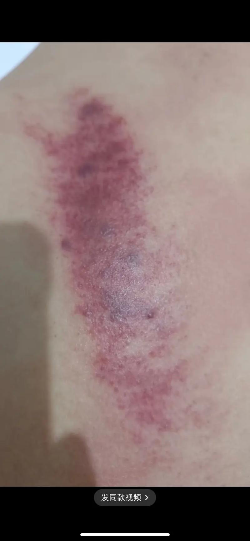 刮痧出的痧是什么