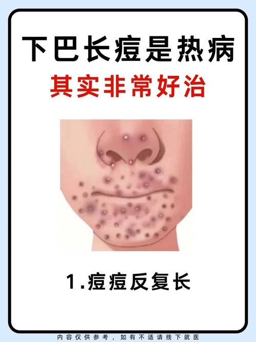 下巴长痘挂什么科