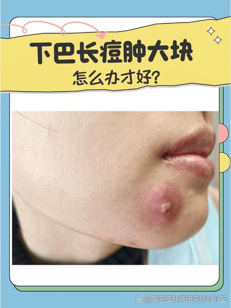 下巴长痘挂什么科